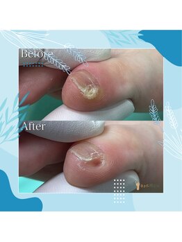 巻き爪補正店 秋葉原店/ 【副爪ケア】