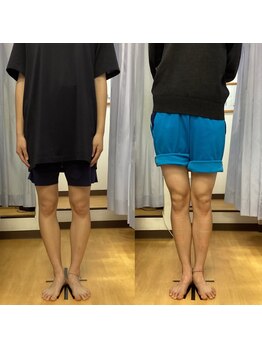 オオシマ整体本院/O脚がずっと気になってました