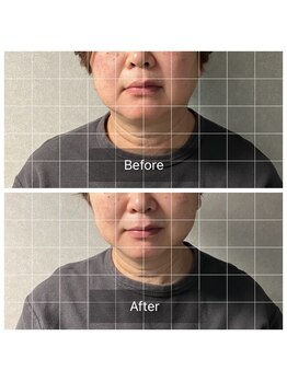 きこりのいずみ/トーンアップコースbefore-after