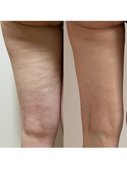 パピヨン(Papillon)/自力で無くせないセル脂肪撃退◎