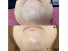 アンド 四條畷店(AND)/リピート率抜群！髭脱毛