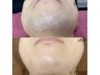 アンド 四條畷店(AND)/リピート率抜群！髭脱毛