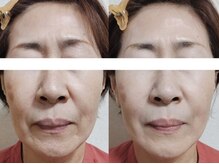 ソアン(Soan)の雰囲気（60代女性 【左：施術前】【右：施術後】）