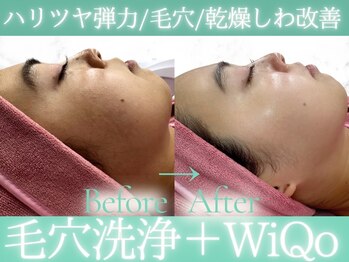 Cスキンケアクリニック 麻布店/ハイドラ+WiQoピーリング