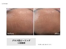 トータルクリア(TOTAL CLEAR)/Gloss肌ピーリング