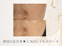 アネラボーテ(Anela Beaute)/進化版ララピール【セラピール】