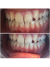 エクシアホワイトニング 代々木店/ホワイトニングビフォーアフター
