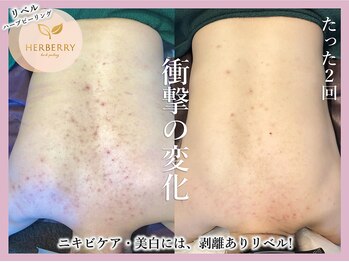 ハーバリー ハーブピーリング 難波心斎橋店(HERBERRYハーブピーリング)/なんばハーブピーリングHERBERRY