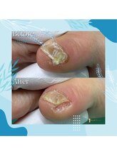 巻き爪補正店 秋葉原店/ 【副爪ケア】