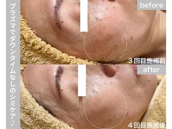 サロン ビュー(salon view)/50代女性〈シミ悩み〉