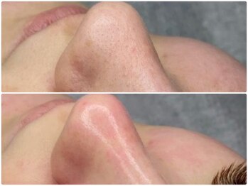 エミマス ボーテ(Emimas Beaute’)の写真/【高濃度水素水でお顔まるごと毛穴洗浄】ホームケアでは落ちきれない毛穴の奥の汚れまでゴッソリ洗浄!