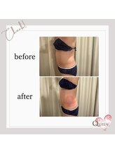 クイーン(QUEEN)/脂肪冷却