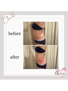 クイーン(QUEEN)/脂肪冷却