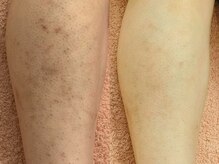 エステ ラミ(Esthe' l'ami)/美肌脱毛