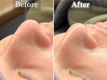 ボーンオム(Born Homme)/毛穴洗浄＋美容液導入：20代女性