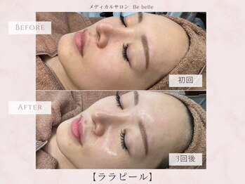 ビベル 八木店(Bebelle)/くすみ改善で若印象