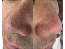 アンドエミニー エン ラボーテ(& EMINY 艶 la beaute)/メンズ毛穴洗浄