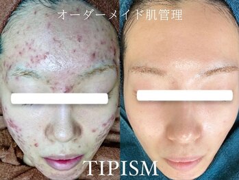 ソリッジ肌管理室の写真/【何をやっても改善しなかった方必見☆】毛穴ケア、ニキビケア 健康的に内側から輝く水々しい肌へ♪