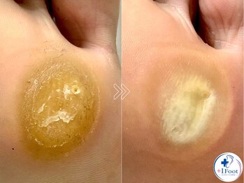 プラスワンフット 本厚木(+1 Foot)/タコ・魚の目ケア！痛みから解放