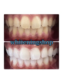 ホワイトニングショップ 高松瓦町店/Before&After美白ホワイトニング