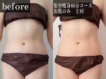 ルピエ(Lupir)/10日後、2回の施術でこの効果！