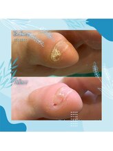 巻き爪補正店 秋葉原店/ 【副爪ケア】