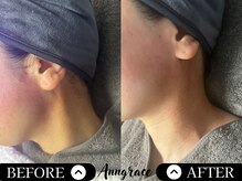 アングレイス(Anngrace)/【顔脱毛もみあげ】Before/After