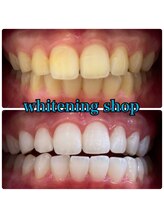 ホワイトニングショップ 大阪玉造店/Before&After美白ホワイトニング