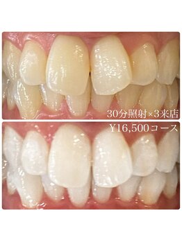 ホワイトニングルーム 川崎店(WhiteningRoom)/ホワイトニング/川崎