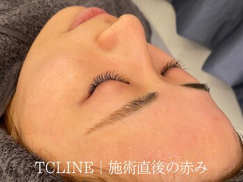 トップスキン 新宿(TOPSKIN)/ハーブピーリングTCLINE施術直後