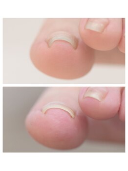 リペディア 熊谷(RePedia)/巻いた爪　施術1回目