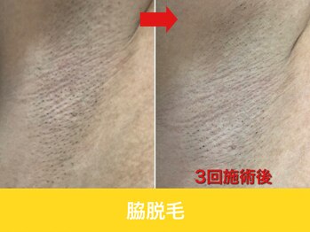 ミスターアンクール 鹿児島(Mr.uncoeur)/脇脱毛3回後