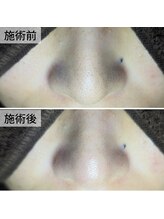 美鼻ラボ 押上 曳舟/黒ずみを徹底除去！