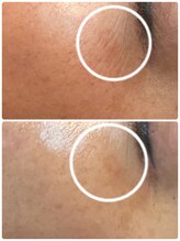 ケイサロン 朝霞店(K salon)/ハーブピーリングbefore・after