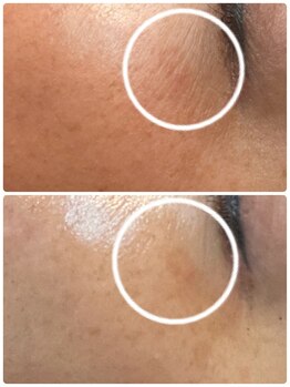 ケイサロン 朝霞店(K salon)/ハーブピーリングbefore・after