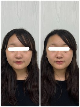 ラフテル鍼灸整骨院/西長堀駅から徒歩2分で小顔整体