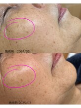 サロン ド エン(Salon de. en)/シミケア◇ハーブピーリング