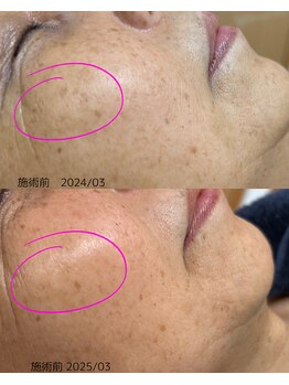 サロン ド エン(Salon de. en)/シミケア◇ハーブピーリング