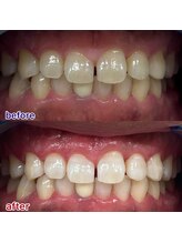 キラット 栃木店(Kiratt)/クリスタルセルフホワイトニング