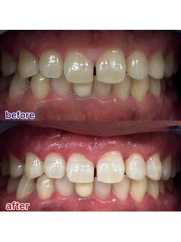 キラット 栃木店(Kiratt)/クリスタルセルフホワイトニング