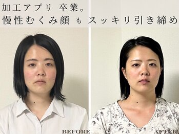 ミラ 長崎駅前店(MIRA)/長崎市_小顔矯正_小顔