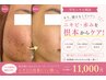 【学生ニキビ相談】プロの肌診断付き◎ニキビ・赤み鎮静ケア