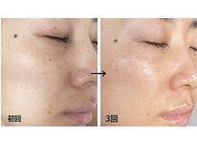 トータルビューティサロン リボーテ(Re:Beaute)/シリカトリートメント