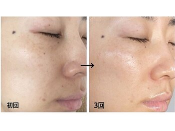 トータルビューティサロン リボーテ(Re:Beaute)/シリカトリートメント