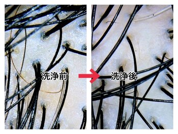 スーパースカルプ 大津店(SuperScalp)/頭皮洗浄before/after