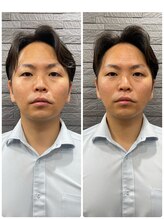 長寿鍼灸院 長寿整骨院/men's美容鍼・超絶コース★