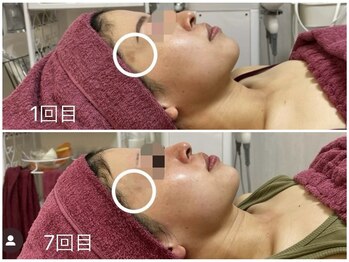 GRACETHOUSAND(グレイスサウザンド)/ハーブピーリング毛穴洗浄