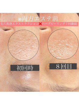 毛穴ケアサロン そらな/頬の毛穴ケア&ハーブピーリング
