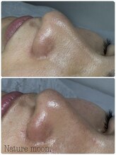 ナチュールムーン(Nature moon.)/男性　毛穴・ハーブピーリング
