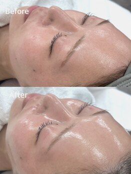 クリアラボ 池袋(Clear Lab)の写真/【韓国式肌管理】毛穴洗浄×ララピールで究極の肌管理★透明感溢れる水光&ツヤ肌でトーンアップが叶います